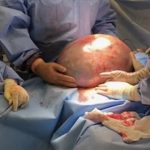 Cerita Wanita Surabaya Idap Kista Sebesar 33 Cm