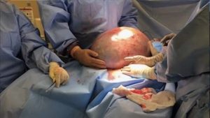 Cerita Wanita Surabaya Idap Kista Sebesar 33 Cm