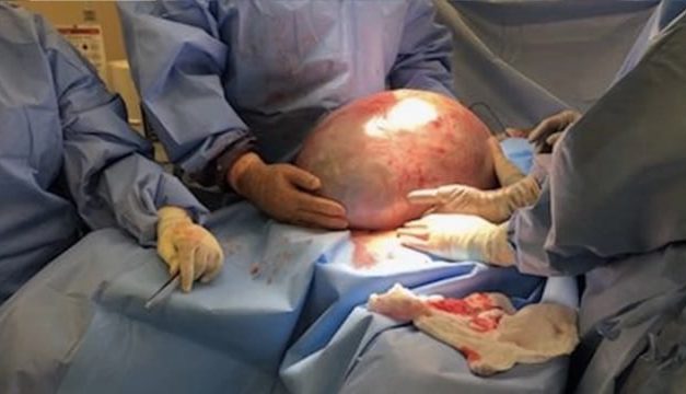 Cerita Wanita Surabaya Idap Kista Sebesar 33 Cm