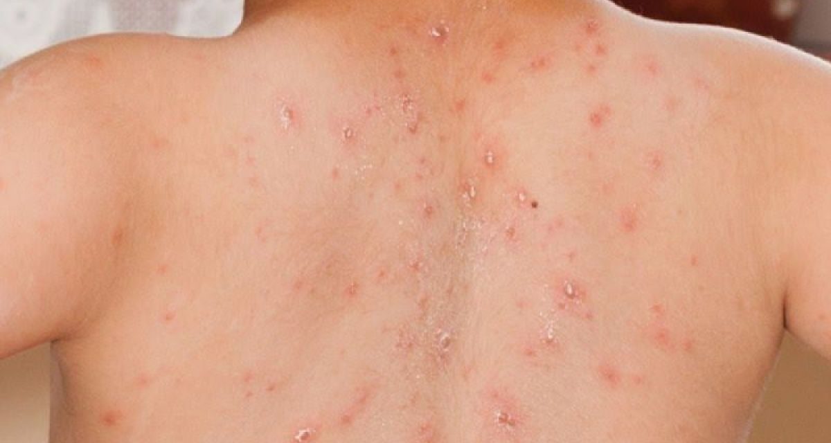 IDAI Sebut Kasus Campak Indonesia Tertinggi Ke-2 Di Dunia