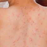 IDAI Sebut Kasus Campak Indonesia Tertinggi Ke-2 Di Dunia