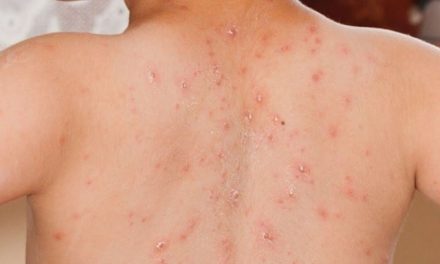 IDAI Sebut Kasus Campak Indonesia Tertinggi Ke-2 Di Dunia